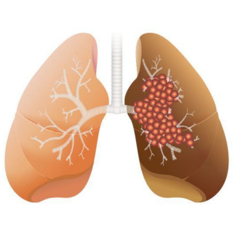 NMNの高用量は、肺腺癌の成長を阻害します